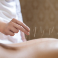 accupuncture-in-nj